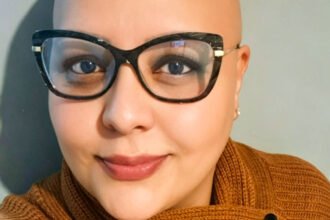 Alopecia areata desafia pacientes a redefinir a própria identidade além da aparência