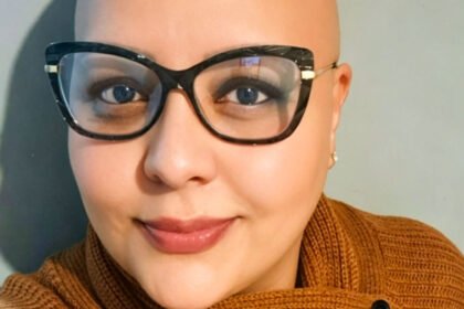 Alopecia areata desafia pacientes a redefinir a própria identidade além da aparência