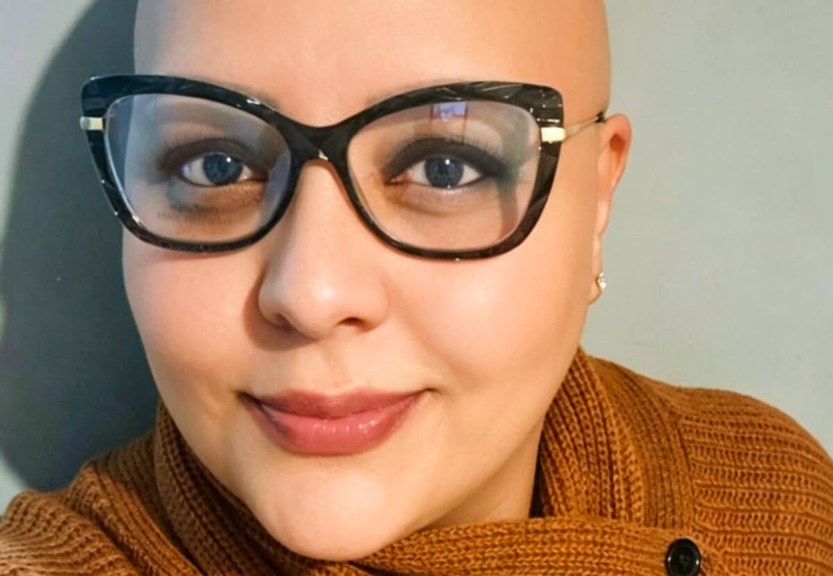 Alopecia areata desafia pacientes a redefinir a própria identidade além da aparência