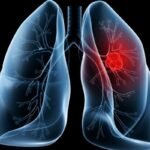 Adenocarcinoma pulmonar submete Papa Leão XIV a procedimento cirúrgico no pulmão direito