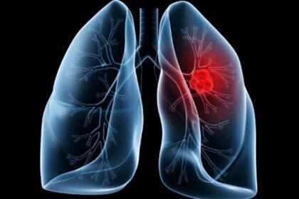 Adenocarcinoma pulmonar submete Papa Leão XIV a procedimento cirúrgico no pulmão direito