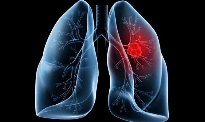 Adenocarcinoma pulmonar submete Papa Leão XIV a procedimento cirúrgico no pulmão direito