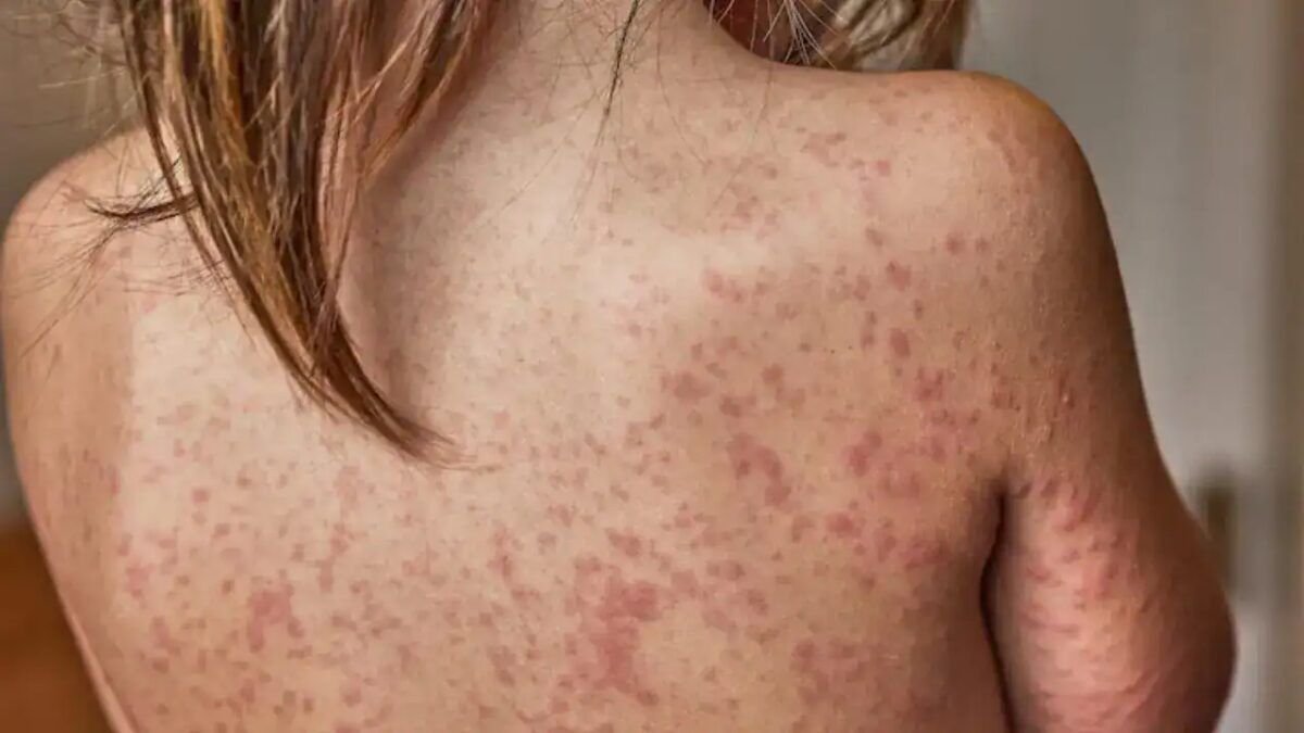 Sarampo exige alerta no Brasil após surtos atingirem níveis recordes nos Estados Unidos